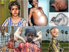 భారత దేశంలోని 10 అరుదైన మెడికల్ కేసులు 