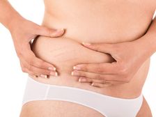 ప్రసవం తర్వాత పొట్ట వద్ద వదులైన చర్మాన్ని తిరిగి టైట్ గా చేసుకోవడానికి మార్గాలు 