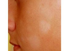 అసహ్యంగా కనిపించే తెల్లమచ్చలు తగ్గించే హోం రెమిడీస్ ? 