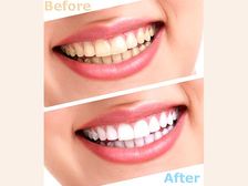 ప‌చ్చ‌గా ఉన్న‌ ప‌ళ్ల‌ను తెల్ల‌గా మార్చే స‌ర్‌ప్రైజింగ్ హోం రెమిడీస్