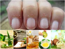 గోళ్ళు చుట్టూ బాధకరమైన క్యూటికల్స్ నొప్పిని తగ్గించే 10 నేచురల్ రెమెడీస్ ..!