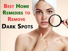 చర్మంలో డార్క్ స్పాట్స్ నివారించే ఎఫెక్టివ్ హోం రెమెడీస్..!