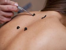 లీచ్ థెరపీ అద్భుతమైన ఆరోగ్య ప్రయోజనాలు..!