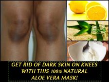మోకాళ్ల నలుపుదనాన్ని వందశాతం పోగొట్టే అలోవెరా మాస్క్..!!