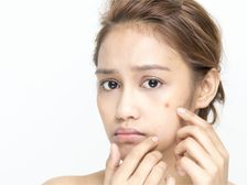 ముఖంలో ఎలాంటి నల్లమచ్చలనైనా మాయం చేసే ఎఫెక్టివ్ హోం రెమెడీస్ ..!