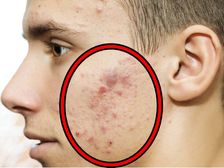 ముఖంలో మొటిమలు పోవాలంటే సింపుల్ టిప్స్ !