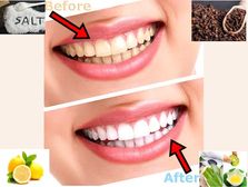 దంతాలపై పాచి తొలగించి, దంతాలు తెల్లగా మెరిపించే 6 ఈజీ హోం రెమెడీస్!