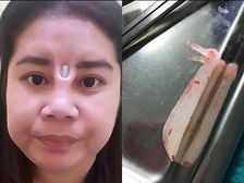 ఈమె అమర్చుకున్న సిలికాన్ ఇంప్లాంట్ ఆమె చర్మాన్ని విపరీతంగా చీల్చుకొని బయటకు వచ్చేస్తుంది 