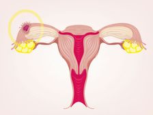 ట్యూబల్ ప్రెగ్నన్సీకి సంబంధించిన 5 లక్షణాలు 