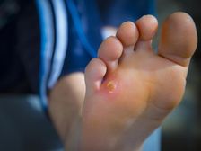 మీ పాదాలపై ఆనెకాయలను తగ్గించే అద్భుతమైన ఇంటి చిట్కాలు