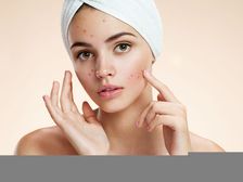 ఈ అలవాట్లు మీ మొటిమల సమస్యను మరింత పెంచుతాయి