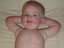 స్లాప్డ్ చీక్ సిండ్రోమ్