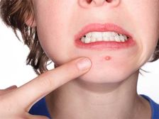 హీట్ బాయిల్స్ ను తగ్గించే బెస్ట్ నేచురల్ రెమెడీస్ 