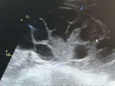 ఒక ఐఫోన్ కొనడం కోసమని  గర్భాశయంలోని అండాలను  అమ్ముకోవడంతో  దాదాపు  చనిపోయే స్థితికి చేరింది!