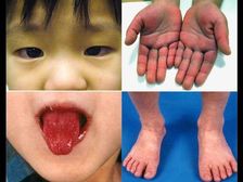 కరోనా తరువాత అమెరికన్ పిల్లలను లక్ష్యంగా చేసుకునే కవాసాకి వ్యాధి - మరియు దాని లక్షణాలు