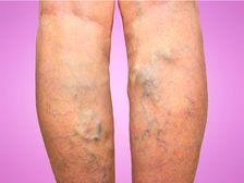 వీరికోజ్ వీన్స్ (అనారోగ్య సిరలు): కారణాలు, లక్షణాలు, రోగ నిర్ధారణ మరియు చికిత్స