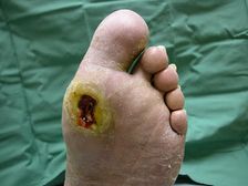 డయాబెటిక్:  పాదాల గాయం లేదా గాయాన్ని విస్మరించవద్దు, ప్రాణాంతకం కావచ్చు..