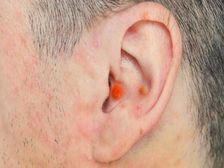 చెవిలోని మొటిమలను తొలగించడానికి ఇంటి నివారణలు