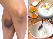 మీ మోకాలు అగ్లీగా లేదా నల్లగా ఉందా? ఈ సమస్యను తగ్గించుకోవడానికి ఇక్కడ కొన్ని మార్గాలు ఉన్నాయి!