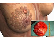 హెచ్చరిక! ఈ ఆహారాలను క్రమం తప్పకుండా తినడం వల్ల రొమ్ము క్యాన్సర్ వచ్చే ప్రమాదం పెరుగుతుందని మీకు తెలుసా?