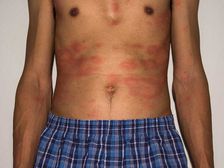 వాతావరణ మార్పుల సమయంలో గజ్జి మరియు తామర నివారించడానికి కొన్ని చిట్కాలు ...!