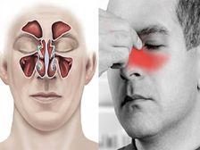 సైనస్ నొప్పి?ఈ సమస్యను ఒక సాధారణ దేశీయ మార్గంలో పరిష్కరించవచ్చు..