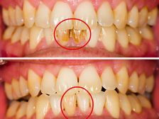  మౌత్ వాష్ తో సమయం వృధా కాదు; దంతాలపై ఎలాంటి మరకలనైనా తొలగిస్తుంది