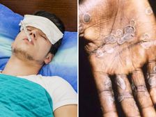Monkey pox: మంకీపాక్స్ అంటే ఏమిటి? లక్షణాలు, తగ్గించుకునే మార్గాలు!
