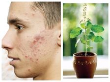 మగవారి ముఖంలో మొటిమలను వెంటనే మాయమయ్యేలా చేసే తులసి మహిమలు...!