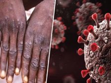 Monkeypox In Delhi: మంకీపాక్స్ క‌ల‌క‌లం..ఢిల్లీలో తొలి మంకీపాక్స్ కేసు గుర్తింపు: దాని గురించి తెలుసుకోవలసినవి
