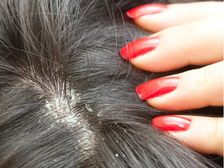Dandruff problem: మౌత్ వాష్ వల్ల మీ తలలోని చుండ్రు పూర్తిగా మాయమవుతుంది... వెంటనే ట్రై చేయండి...