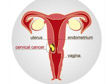 Cervical Cancer Vaccine: గర్భాశయ క్యాన్సర్ కు దేశీయ టీకా.. ఇవాళ్టి నుండి అందుబాటులోకి 