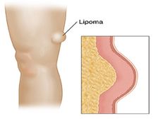 What is Lipoma: చర్మం కింద గడ్డలు మీకూ ఉన్నాయా? అవెంటో తెలుసా? 