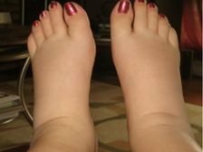 కాళ్ల వాపు కిడ్నీ జబ్బుకు సంకేతమా? నిజమెంతా? 