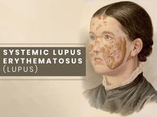 Lupus: రక్షించేవే భక్షించడం మొదలు పెడితే.. లూపస్ అంటే ఏంటి?