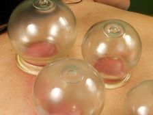 Cupping Therapy: ఎంత కష్టపడ్డా బరువు తగ్గలేకపోతున్నారా.. ఈ థెరపీతో ఈజీగా తగ్గేస్తారు 