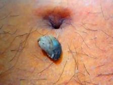 Navel Stone: బొడ్డు చుట్టూ నొప్పి వస్తోందా? రాళ్లు ఏర్పడ్డాయేమో!