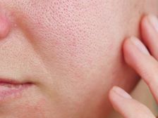 Face Pack for Pores: మీ ముఖంలో చర్మం రంద్రాలా.. వికారంగా ఉందా?ఇలా ఫేస్ ప్యాక్ వేసుకుంటే రంధ్రాలు కవర్ చేస్తాయి