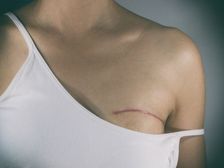  Breast Cancer:ఈ లక్షణం ఉన్న స్త్రీలకు బ్రెస్ట్ క్యాన్సర్ వచ్చే ప్రమాదం చాలా ఎక్కువ... వెంటనే చెక్ చేసుకోండి.!