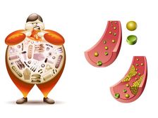 ఈ ఆహారాలు మీ కొలెస్ట్రాల్ స్థాయిలను సైలెంట్ గా పెంచుతాయి...జాగ్రత్త...!