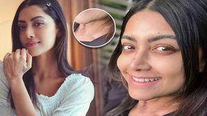 Mamta Mohandas: మమతా మోహన్‌దాస్‌కు బొల్లి వ్యాధి, ఎందుకొస్తుంది, లక్షణాలు ఏంటంటే.. 