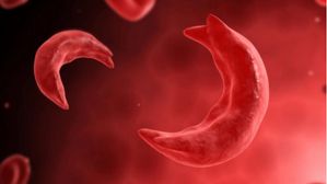 Sickle Cell Anemia: సికిల్ సెల్ అనీమియా అంటే ఏంటి? లక్షణాలు, చికిత్స గురించి తెలుసుకోండి