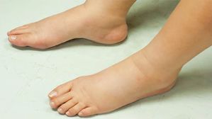 మధుమేహ వ్యాధిగ్రస్తులలో పాదాల వాపును తగ్గించడానికి తక్షణ పరిష్కార మార్గాలు