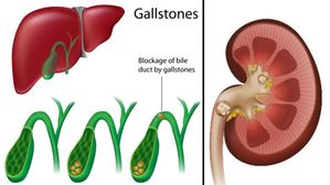 Kidney VS Gallbladder Stones: కిడ్నీ స్టోన్స్, గాల్ బ్లాడర్ స్టోన్స్ రెండింటి లక్షణాలు వేరు, నిర్లక్ష్యం చేయొద