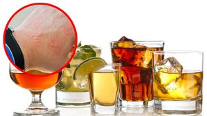 Liquor Allergy: మందు తాగితే ఈ అలెర్జీ! దేశంలో మొదటి కేసు నమోదు.. లక్షణాలు ఏంటంటే?