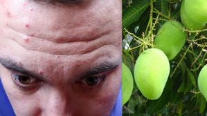 మామిడి పండ్లు తింటే ముఖంపై మొటిమలు ఇబ్బంది పెడుతున్నాయా? 