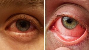 విపరీతంగా పెరిగిపోతున్న కండ్లకలక కేసులు - ఈ జాగ్రత్తలు తీసుకోకపోతే మీకూ రావొచ్చు సుమీ!