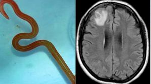ప్రపంచంలోనే మొదటి కేసు:రోగి మెదడులో మెదులుతున్ననులిపురుగు, 6నెలల నుండి నరకం. స్కానింగ్ తో షాక్ తిన్న వైద్యులు