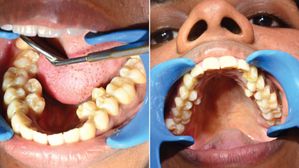  32 కాదు ఏకంగా 38 పళ్లతో గిన్నిస్ రికార్డు సృష్టించిన మహిళ !