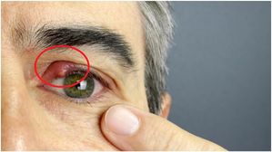 ఇవి కంటి క్యాన్సర్ కు ప్రారంభ లక్షణాలు, ఈ లక్షణాలు శరీరానికి వ్యాపించక ముందే తగిన జాగ్రత్తలు తీసుకోండి